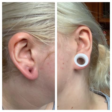 so i stretched one of my ears too fast. it swelled and teared