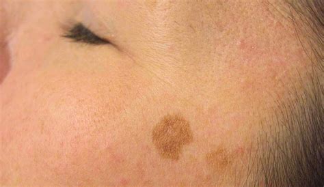 advanced age spot treatment  adelaide restore youthful clear skin