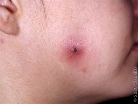 bed bug bites  mosquito bites