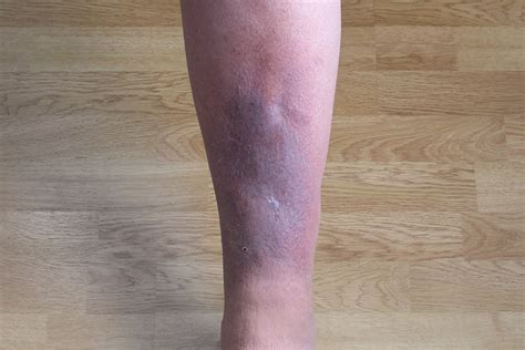 Can You Get a DVT in Your Arm? » Scary Symptoms
