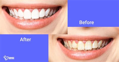 A Full Guide to Dental Bridge + Before and After Work Photos - Enhance ...