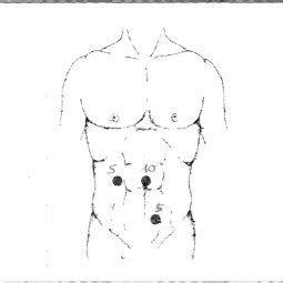 Position of the trocars in laparoscopic appendectomy. | Download ...