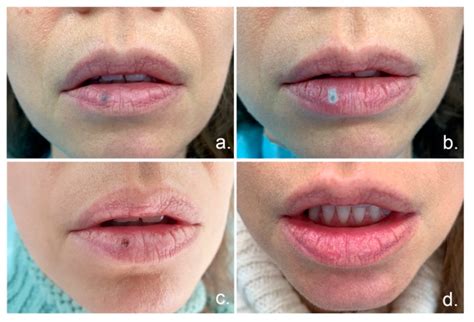 Venouslakestreatment Advanced Cosmetic Medicine