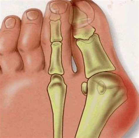 Exercises To Improve Foot Strength - The Prehab Guys
