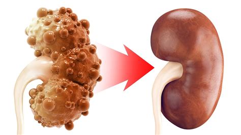 real   chronic kidney disease  polycystic kidney disease