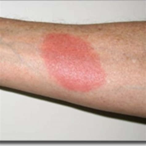 How to Use Aromatherapy Essential Oils for First Aid Treatment - HubPages