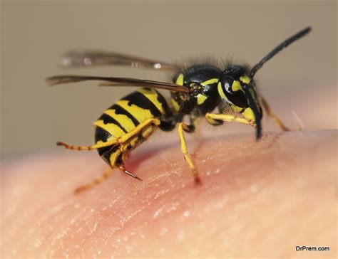 How to deal with bee sting | Live A Great Life Guide & Coaching with Dr ...