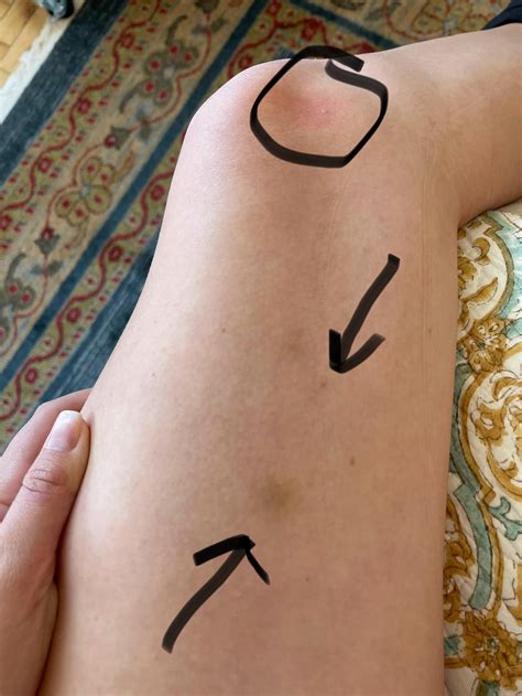 Scabies or Spongiotic Dermatitis?? : r/scabies