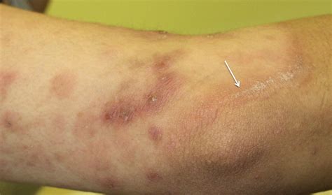 differential diagnosis  atopic dermatitis immunology  allergy