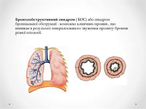 Бронхообструктивний синдром - презентация онлайн