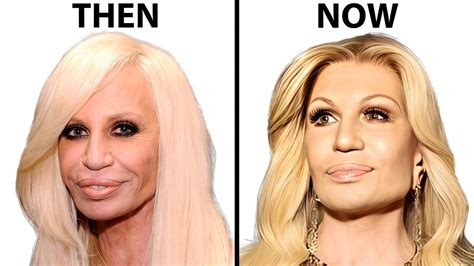 Donatella Versace's NEW FACE | Plastic Surgery Analysis | Celebrity