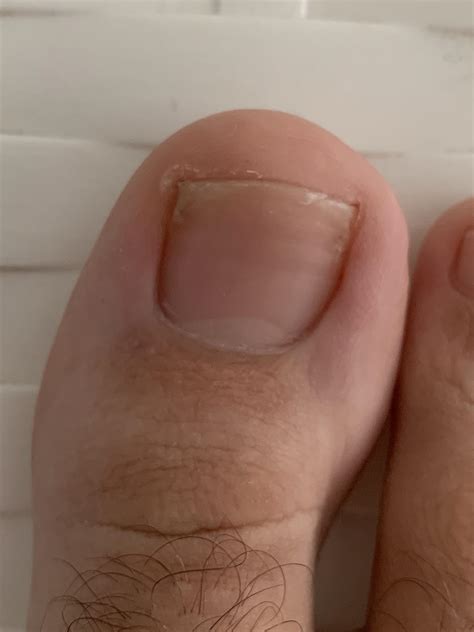 why does my toenail look like this? : r/DiagnoseMe