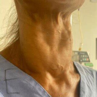 Diffuse enlargement of the thyroid gland on hospital admission ...