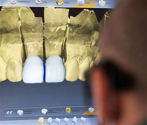 Digital Impressions - Dentist Digital Workflow - Elite Dental Lab Gold