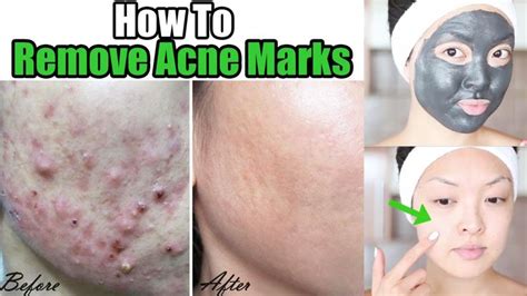 Remove Acne Marks || 6 Easy & Quick Ways To Remove Acne Marks at Home ...
