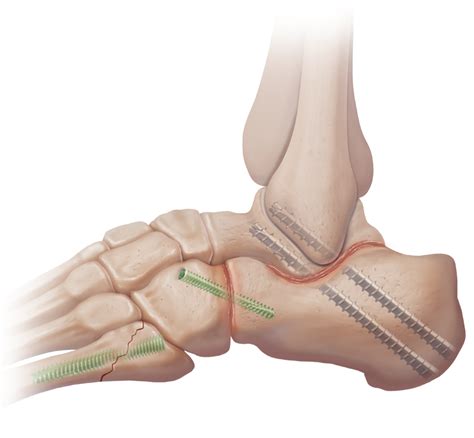 Arthrex - Subtalar Arthrodesis