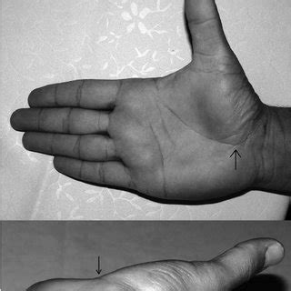 (PDF) Value of anatomic landmarks in carpal tunnel surgery