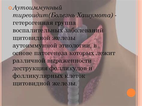 Аутоимуное заболевание щитовидной железы: Болезнь Хашумота ...