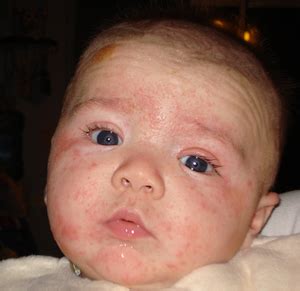 Baby Eczema on Face | Dyshidrotic Eczema Treatment
