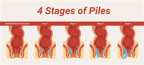 Piles Vs Fissure: Know Difference Between Piles and Fissure