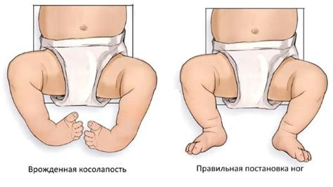 Врожденная косолапость у детей | orto.kdpmc.ru
