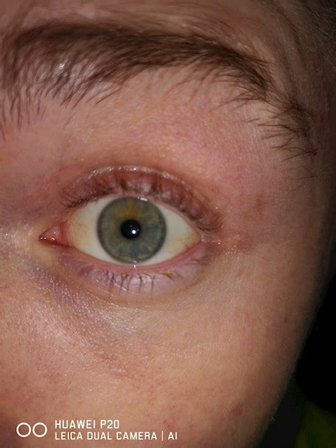 Yellowing my eyes(my eyes are getting yellow) - Pain Concern