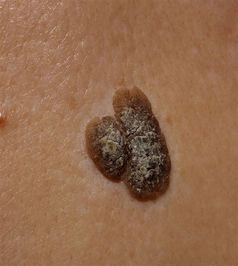 Flat Wart Vs Seborrheic Keratosis at Paulette Reynolds blog