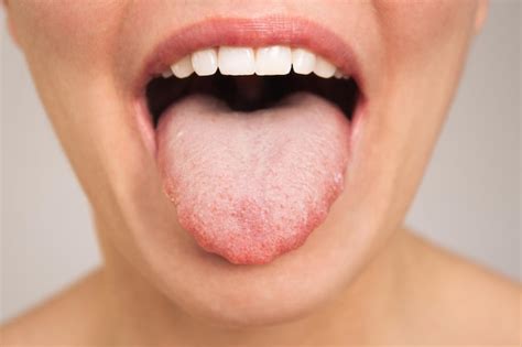 Marca De Dentes Na Língua - Mulher caucasiana abre a boca e mostra uma língua doente com marcas de ...