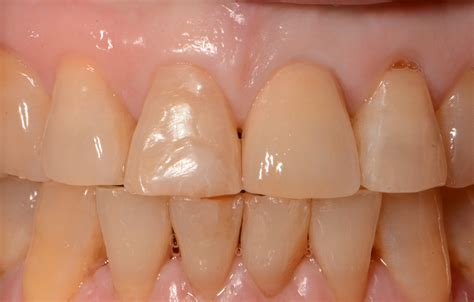 Dental Implants | Pacific Spirit Dental, Vancouver