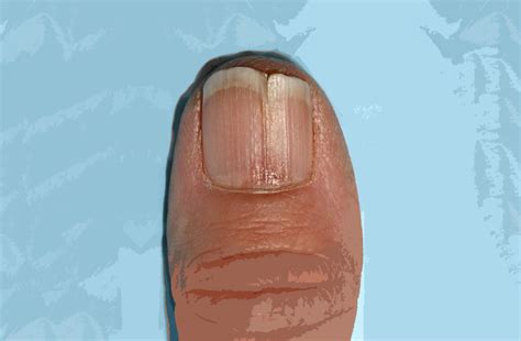Онихорексис ногтей: как лечить? Причимы и симптомы