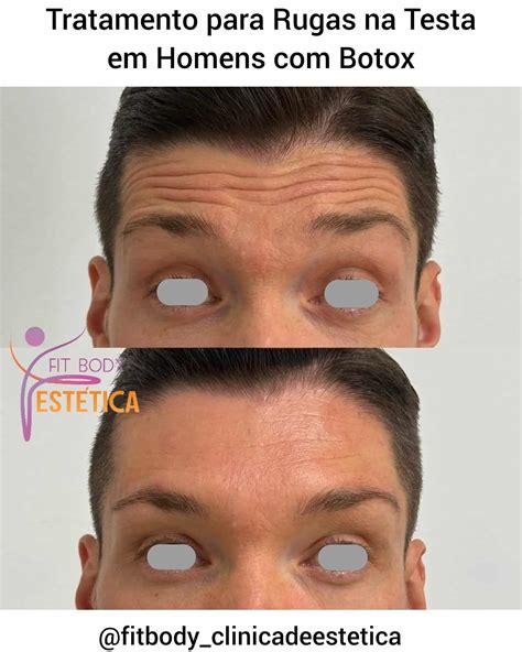 Botox No Pénis Antes E Depois - Botox Masculino Antes e Depois - Clínica Fit Body Estética