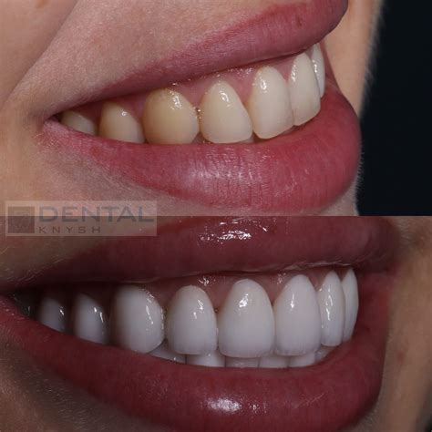 Вініри Львів | Вініри ціна Львів | Стоматологія DentalKnysh