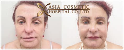 cheek augmentation  thailand cheek implants asia cosmetic hospital