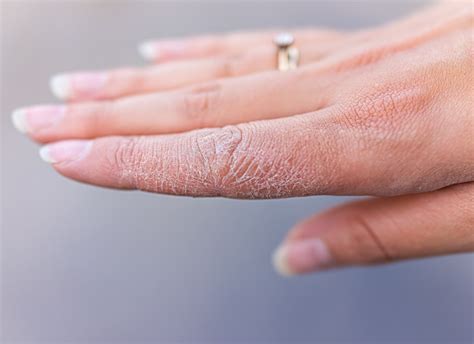 mild dyshidrotic eczema fingers