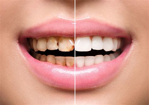 How Long Do Dental Veneers Typically Last?