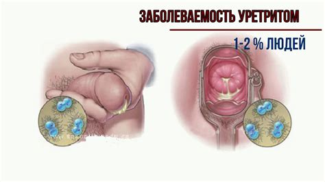 Уретрит лечение от уролога пошагово. - YouTube