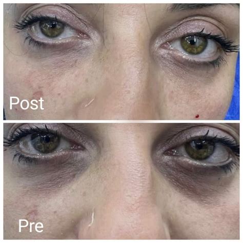 dark circles treatment  hurghada book  freshness center