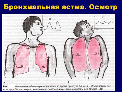 Бронхиальная астма - презентация онлайн