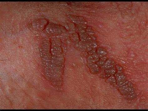 Verrugas genitales en hombres | VPH en hombres, causas, síntomas y