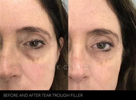 filler for bags under eyes