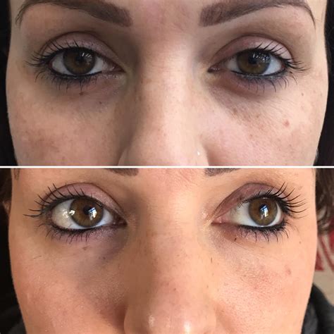 Platelet-rich plasma (PRP) therapy - Injector Maya