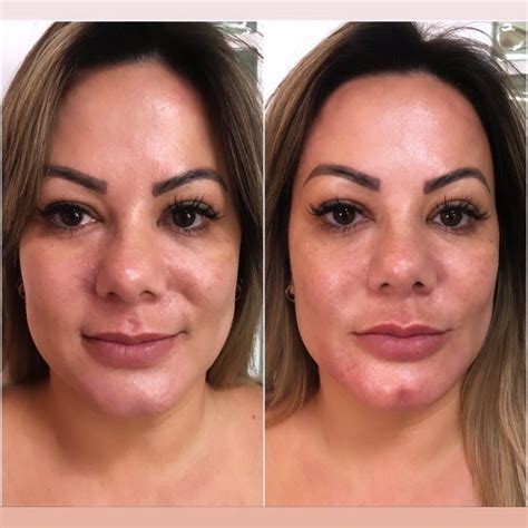 Enzima Phd Antes E Depois - Aplicação De Enzimas No Rosto Antes E Depois - Cultura Notícias