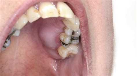 How To Get Rid Of Abscess - Signexercise2