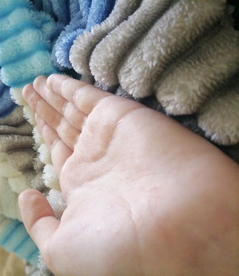 Водянистые пузыри на руках - Вопрос дерматологу - 03 Онлайн