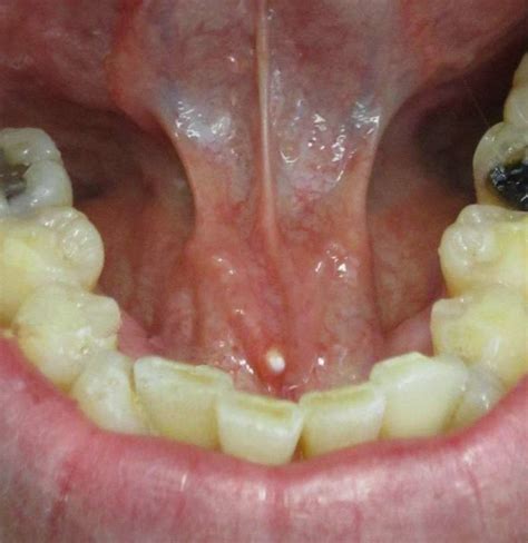 Painful Tag Under Tongue _ White Spots on Tongue: 7 Pictures to Compare
