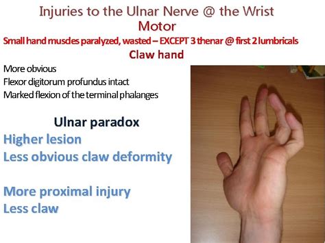 ULNAR NERVE ANATOMY Its LESIONS Dr Mukesh Singla