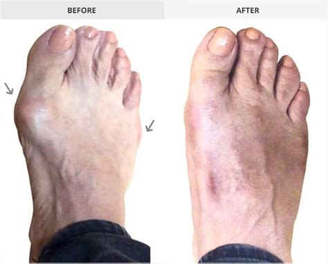 Bunion Surgery Before & After Gallery | Bunion Institute LA