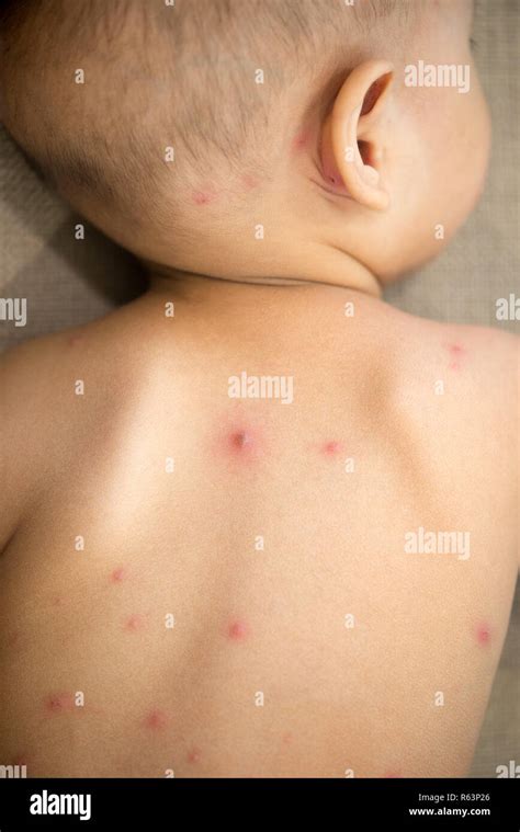 baby skin rash  res stock photography  images alamy