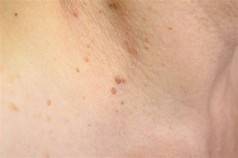 Wratten: onze behandelingen | Medical Skincare - huidartsenpraktijk