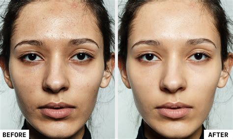 chemical peeling cost  india treatment process
